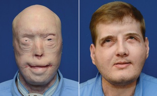 Le greffé du visage Patrick Hardison avant son opération, en 2014 et un an après, en août 2016.