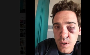 Alexandre a le nez et le sinus maxillaire fracturés.