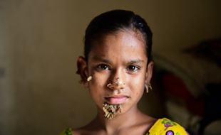 Sahana Khatun, dix ans, présente bien les répugnantes excroissances géantes caractéristiques de l'épidermodysplasie verruciforme.