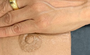 La prothèse mammaire externe sur laquelle le CHU de Toulouse lance son essai clinique reproduit la couleur de la peau de la patiente.