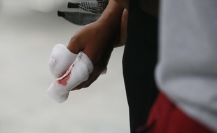 Illustration de blessures aux doigts.
